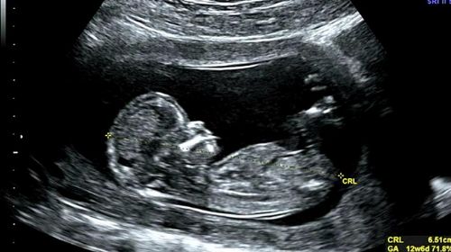 Pro-Abortion Lawsuit Falsely Claims Killing Babies in Abortions is Medically Necessary