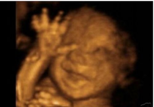 Donald Trump Was Right, Democrats Support Abortions Up to Birth and Infanticide